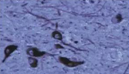 74d013cd-2c71-4459-99e5-2338fda200f6 正常人:黑质神经元存在